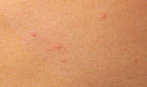 bumps on skin 