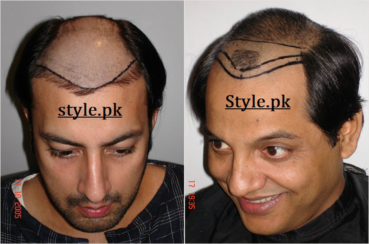 Pakistani Celebrities With Hair Transplant - The Hidden Truth Behind The  Young Looks Of Celebrities
